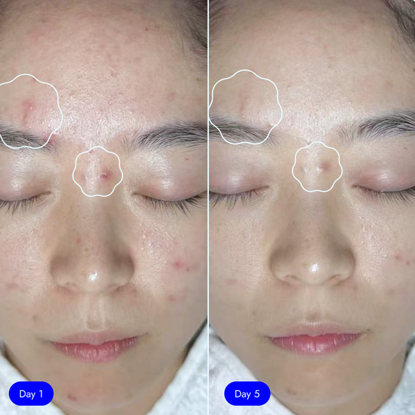 <p>Acne, breakouts</p>