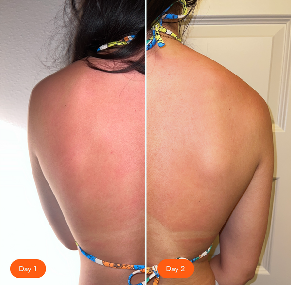 <p>Sunburns, skin damages</p>