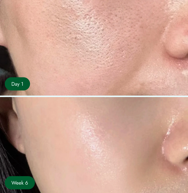 <p>Texture, clogged pores</p>