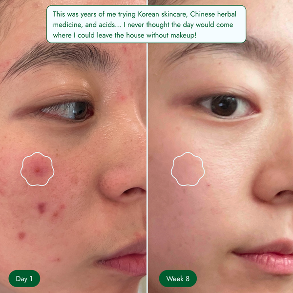 <p>Overproduction of sebum</p>