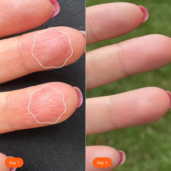 <p>Ezcema, dryness</p>